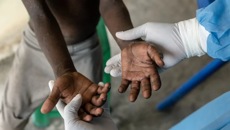 Le Congo, confronté à une épidémie de mpox mutante, manque cruellement de ressources pour endiguer le virus et protéger sa population.