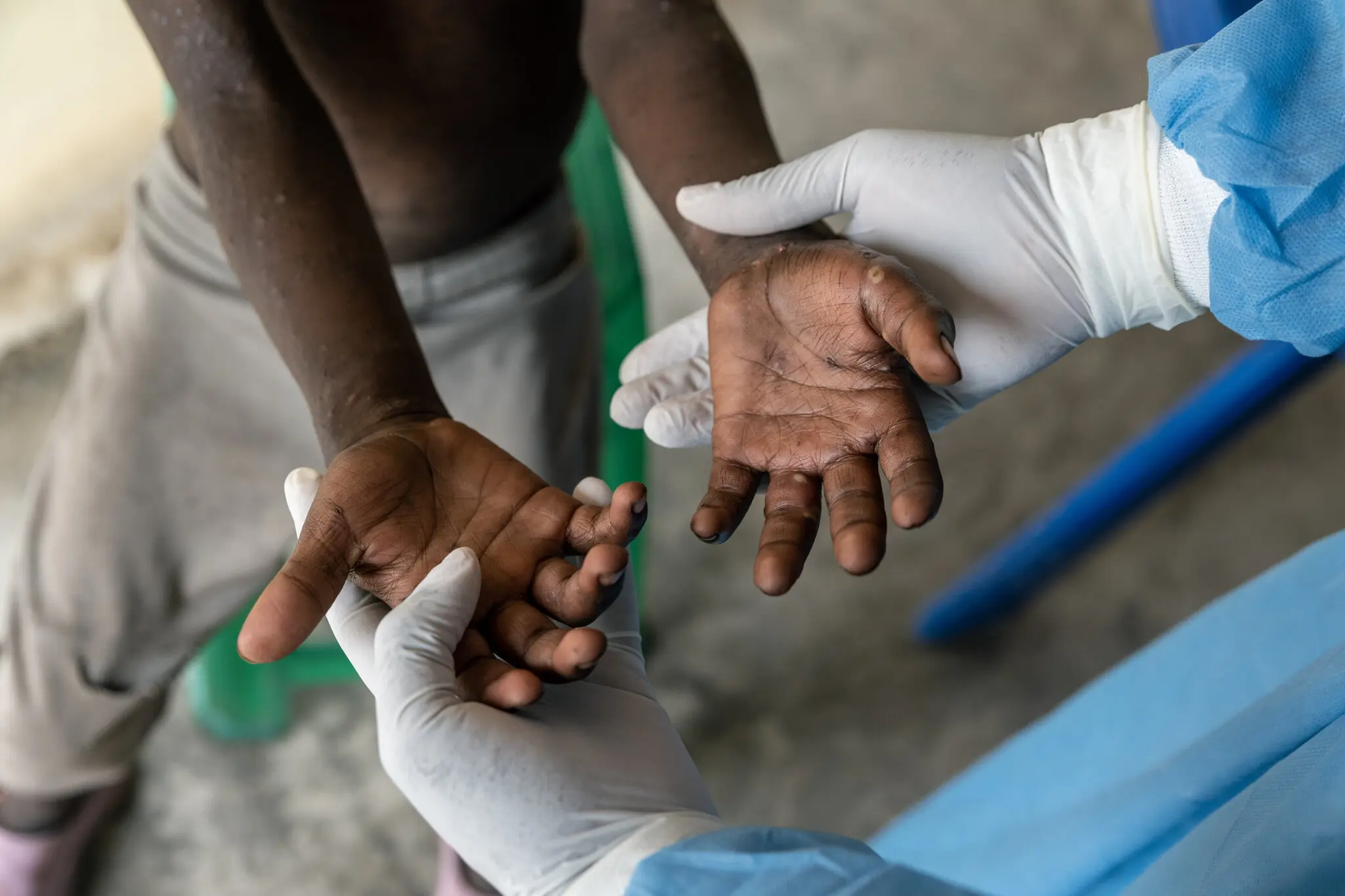 Le Congo, livré à lui-même face à une épidémie de MPOX mutante