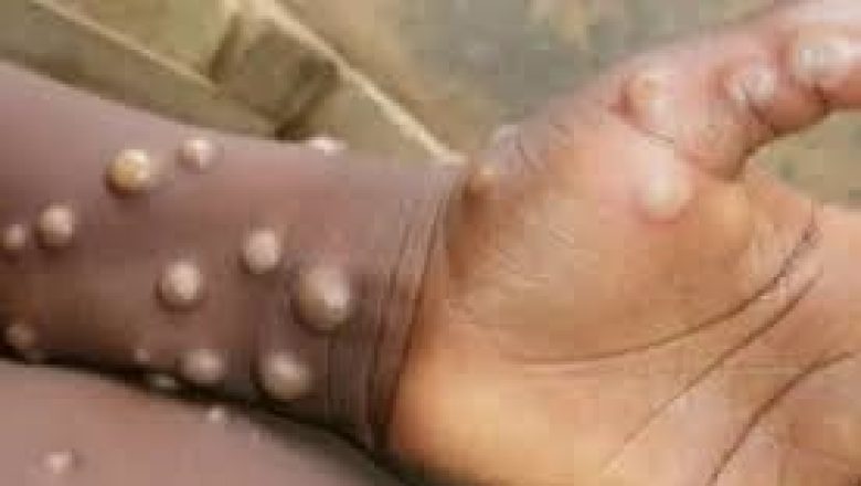 La variole du singe sévit en Afrique : l'OMS alerte sur une épidémie sans précédent et appelle à une réponse mondiale coordonnée.