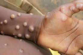 La variole du singe sévit en Afrique : l'OMS alerte sur une épidémie sans précédent et appelle à une réponse mondiale coordonnée.