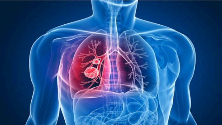 La Journée mondiale de lutte contre la tuberculose est essentielle pour sensibiliser à une maladie évitable, mais toujours meurtrière,