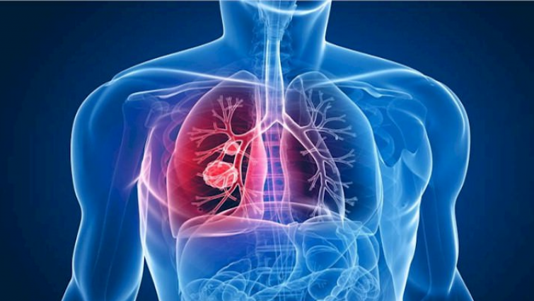 La Journée mondiale de lutte contre la tuberculose est essentielle pour sensibiliser à une maladie évitable, mais toujours meurtrière,
